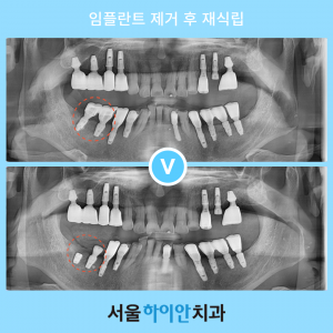 둔산동치과 임플란트 보철물이 파절되었다면