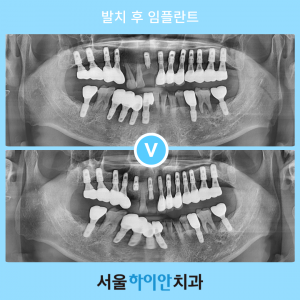 대전서구치과 기존 임플란트를 활용하여