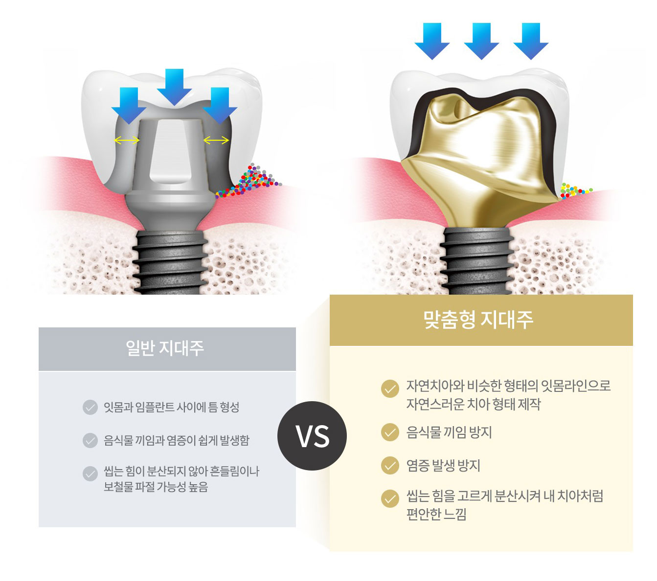일반 지대주와 맞춤형 지대주 비교